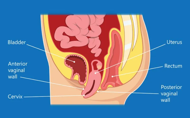 Detection of Bladder Prolapse