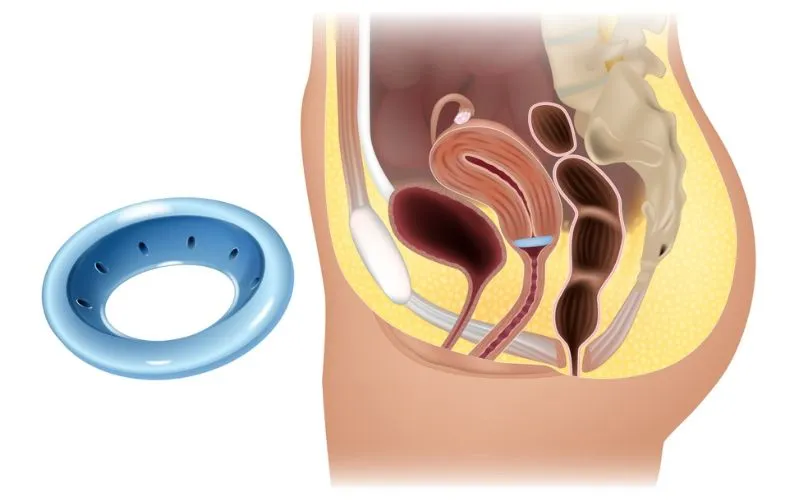 Future of Bladder Prolapse Diagnostics